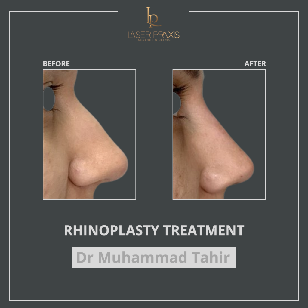 Rhinoplasty2-1024x1024