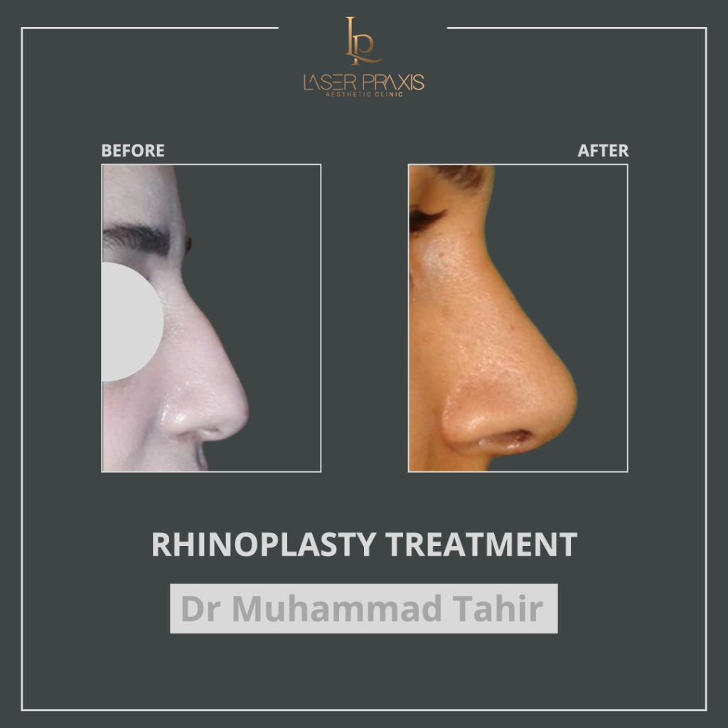 Rhinoplasty3-1024x1024
