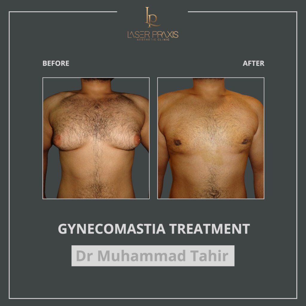 gynecomastia1-1024x1024