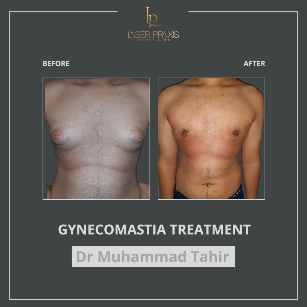 gynecomastia2-1024x1024
