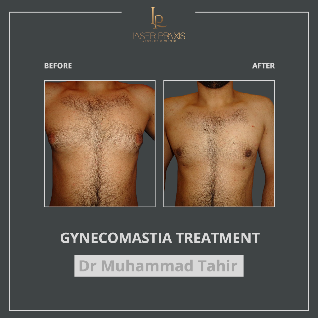 gynecomastia3-1024x1024