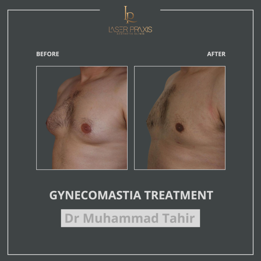 gynecomastia4-1024x1024