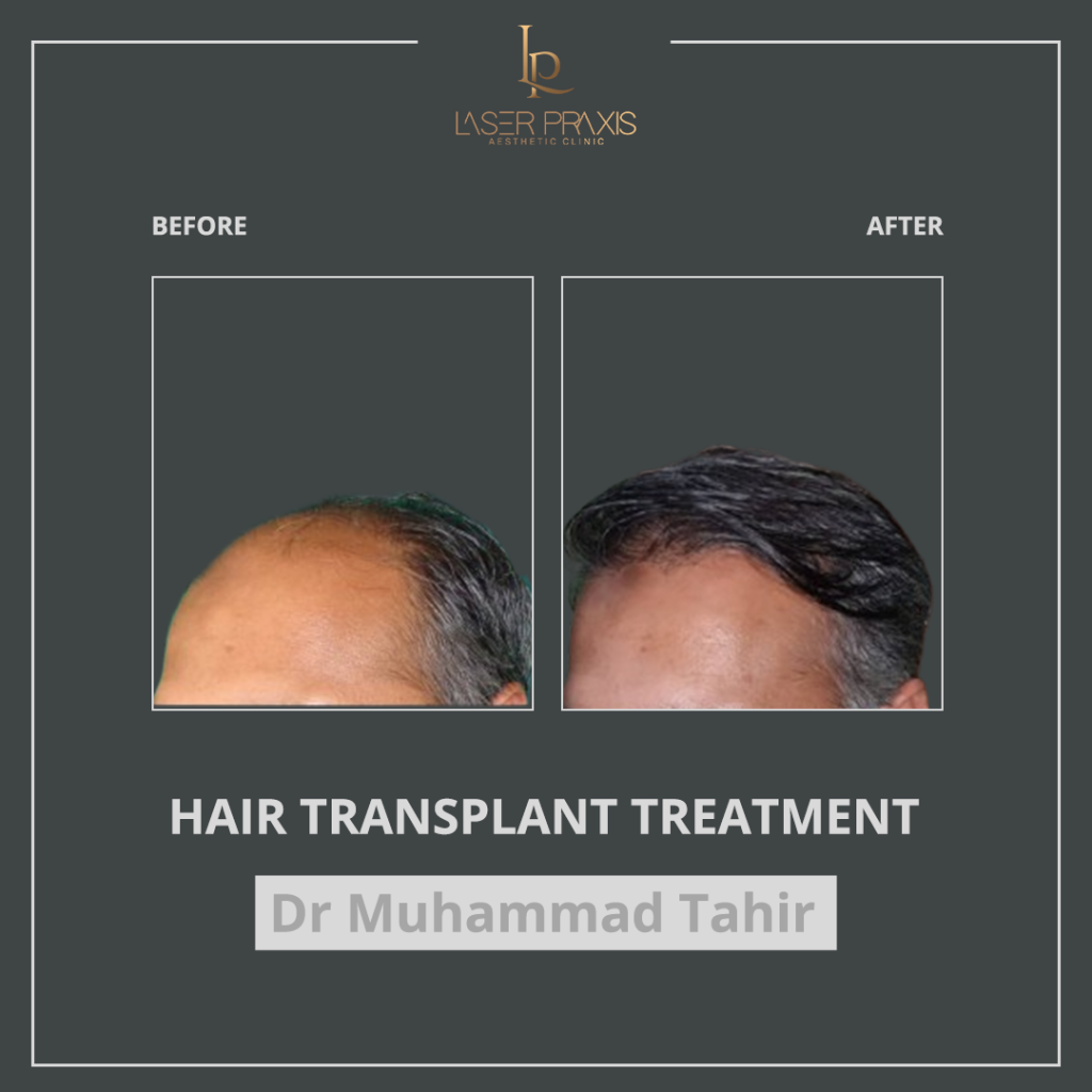 hair-transplant3-1024x1024