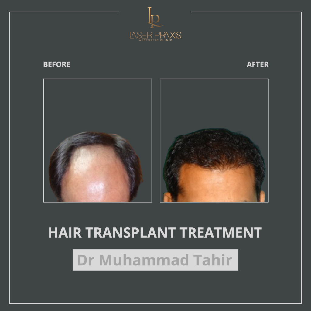hair-transplant4-1024x1024