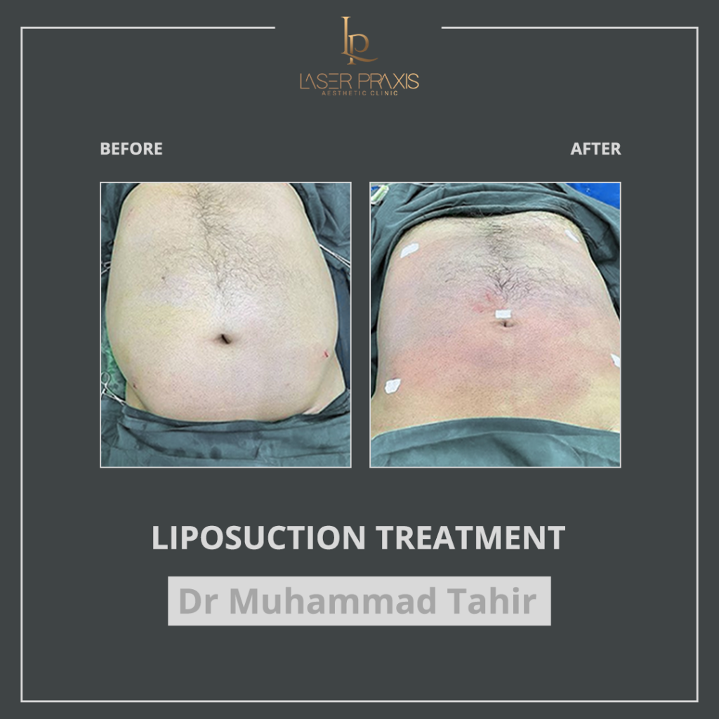 liposuction1-1024x1024