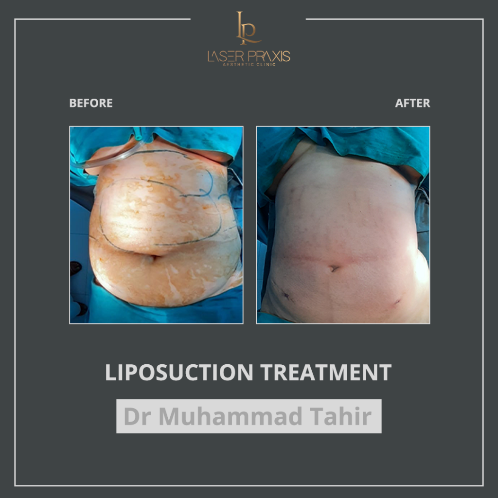 liposuction2-1024x1024