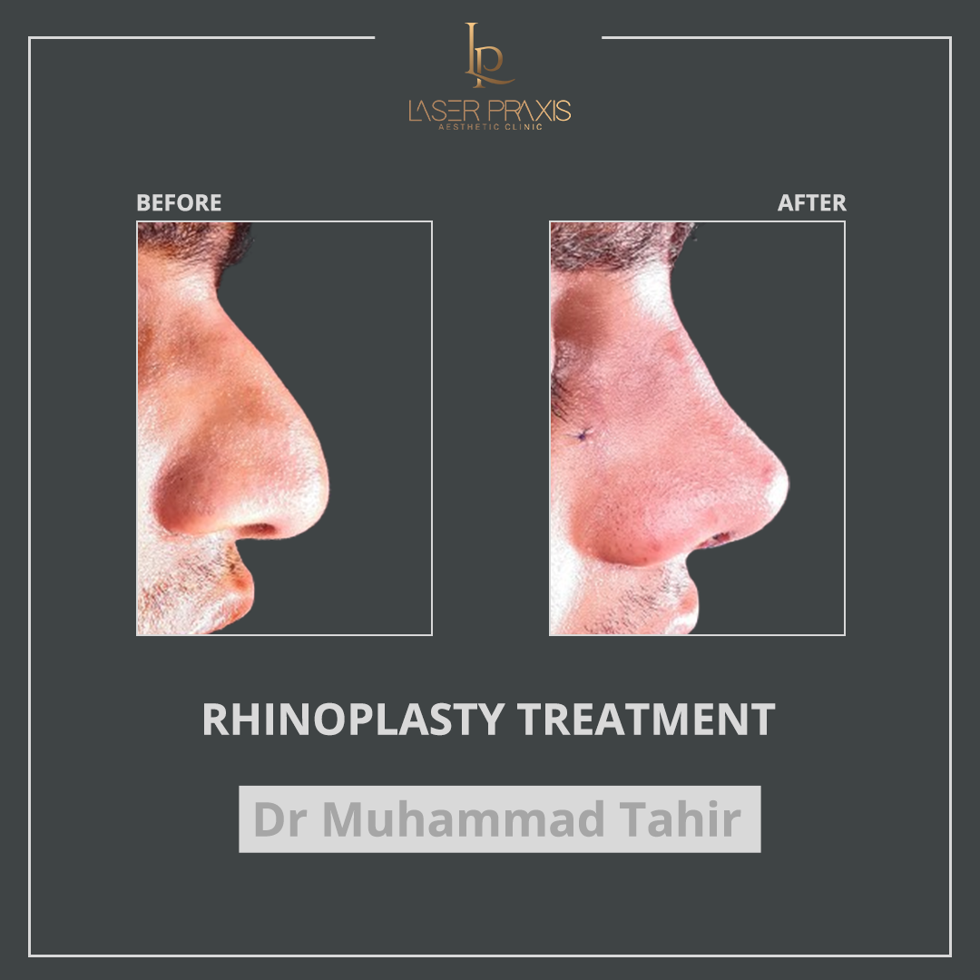 Rhinoplasty1111