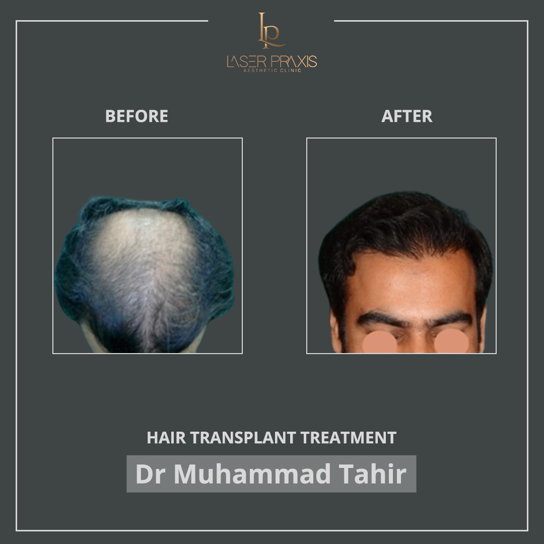 hairtransplant11111111